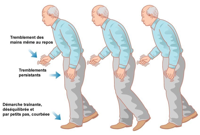 l'image décris un Viel homme qui est courber, tremblant et qui traine les jambes  ce sont les trois principaux  symptôme de la maladie de parkinson